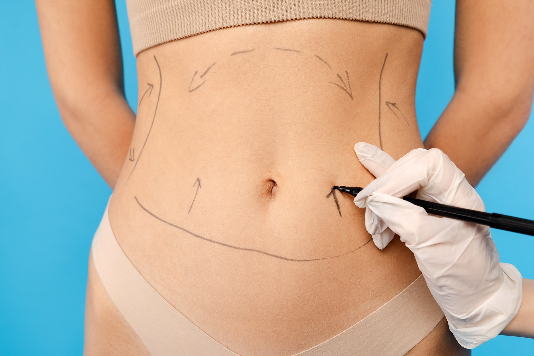 La mano del cirujano traza sobre el abdomen las líneas de la intervención, en un tratamiento de Abdominoplastia de Clínica Malai en Bilbao