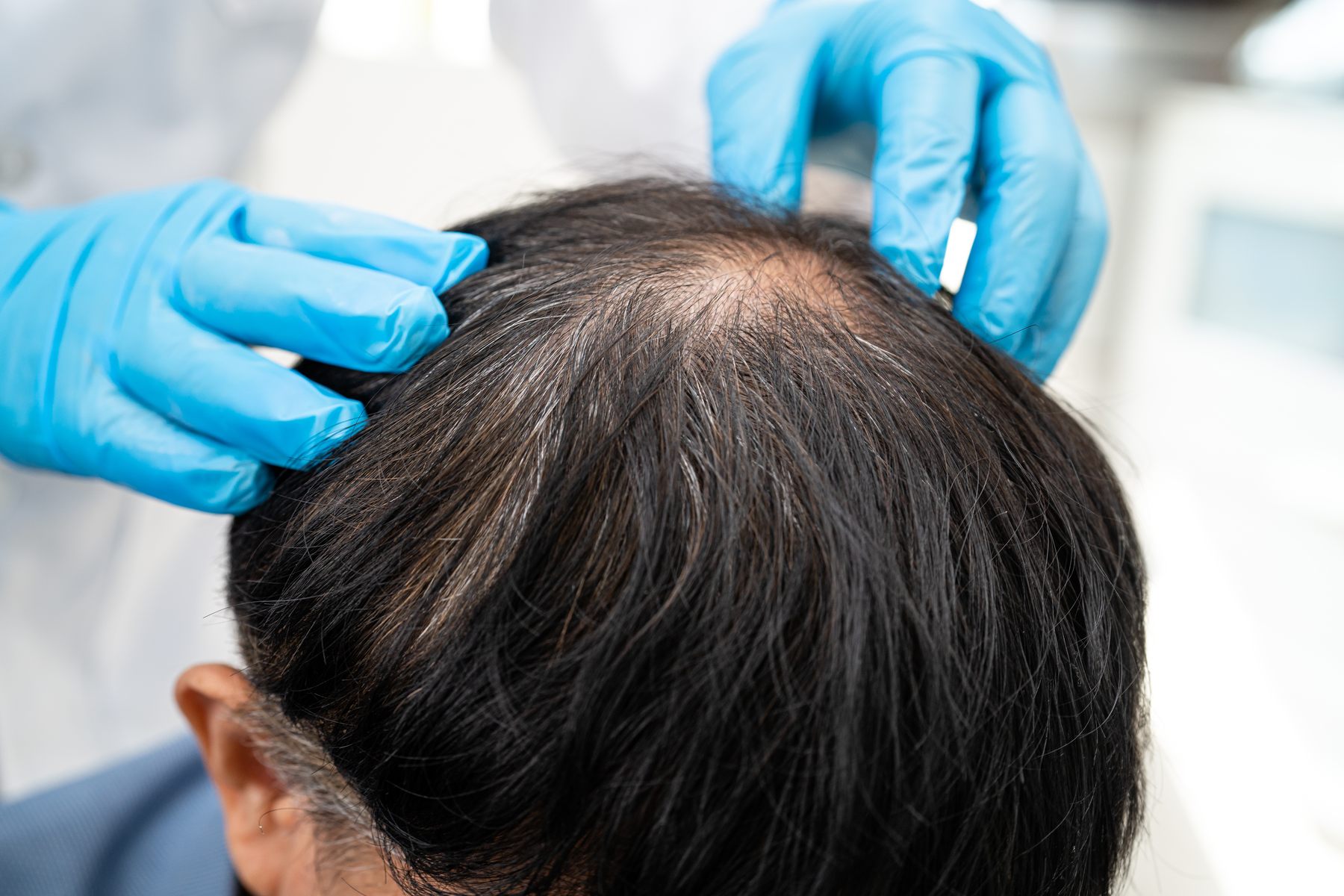 Exploración del cuero cabelludo en consulta, con guantes, en un tratamiento de Alopecia areata de Clínica Malai en Bilbao