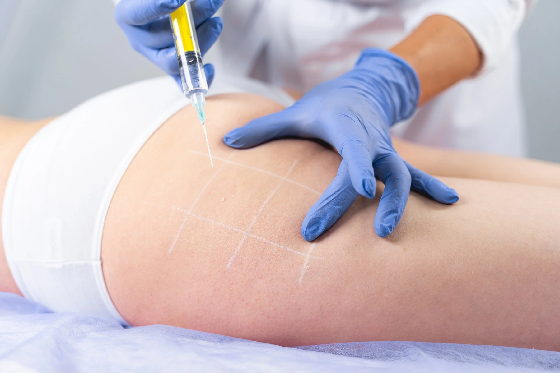 Infiltración de mesoterapia corporal en la zona de grasa localizada, en un tratamiento de Celulitis y grasa localizada de Clínica Malai en Bilbao