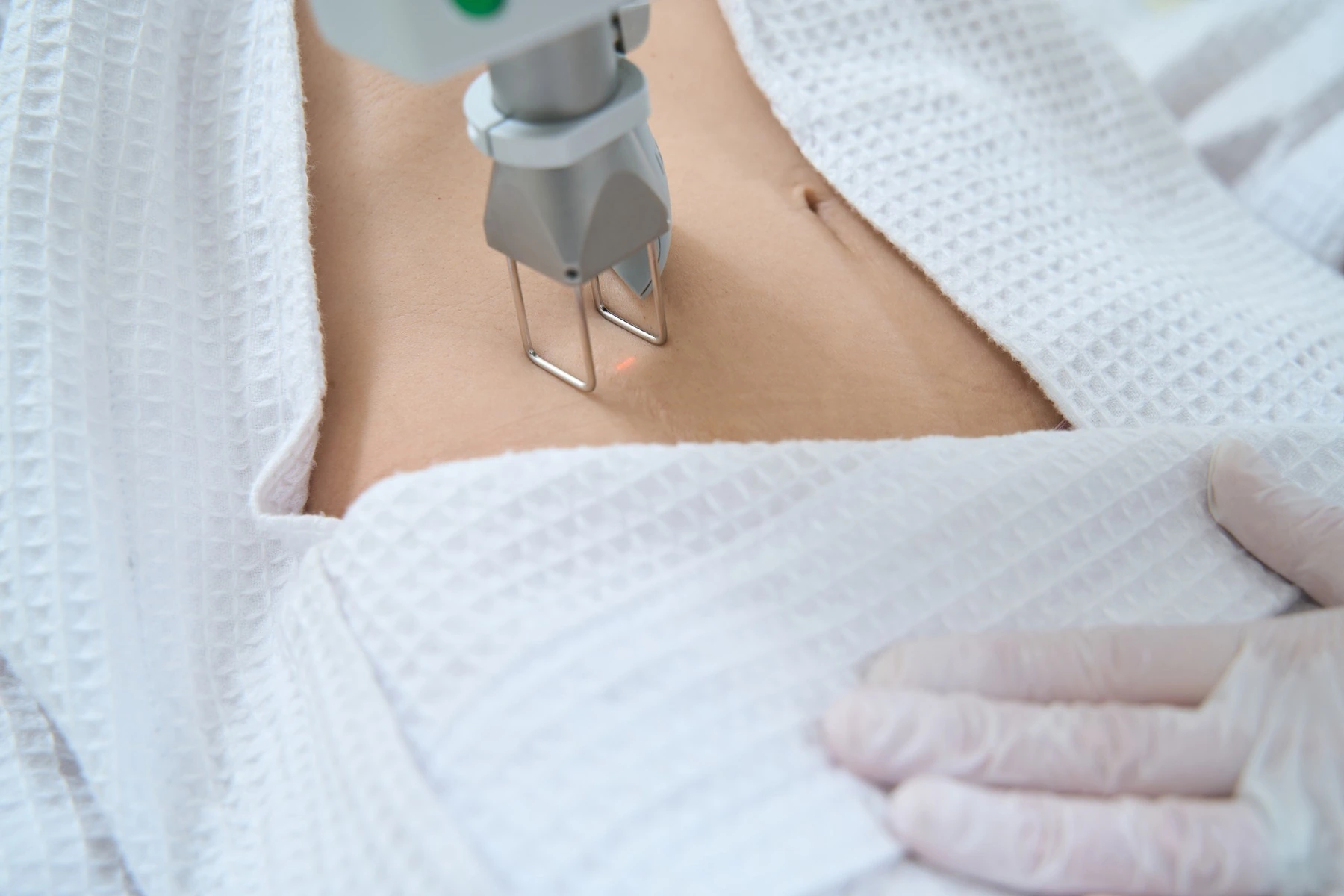 Aplicación de láser sobre el abdomen para mejorar el aspecto de la piel, en un tratamiento de Cicatrices y estrías de Clínica Malai en Bilbao