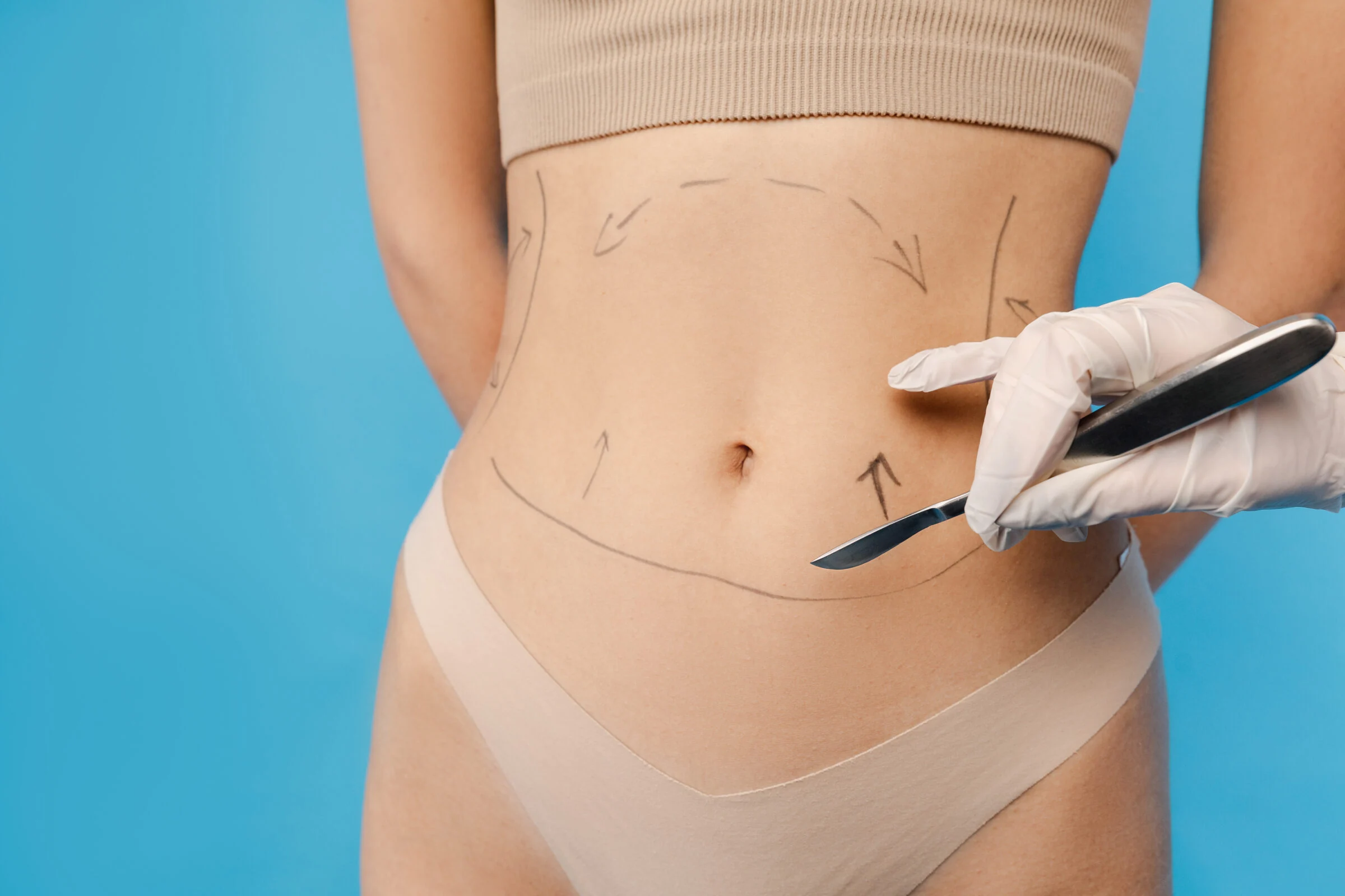 Medicina estética en Bilbao: marcaje de la zona corporal antes de una intervención