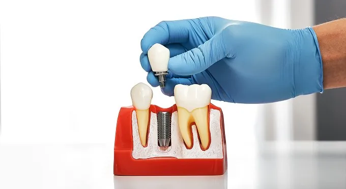 Implantes dentales en Bilbao: profesional mostrando la colocación de un implante dental sobre un modelo