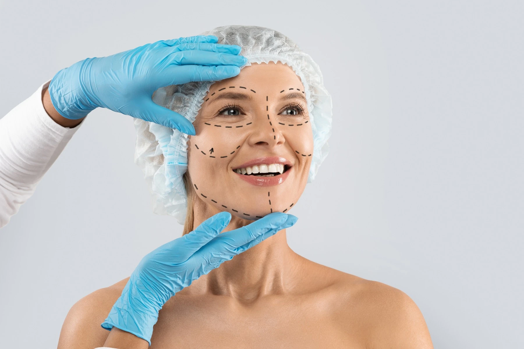 Lifting facial y cervical en Bilbao: rostro marcado con las líneas de la intervención durante la valoración previa