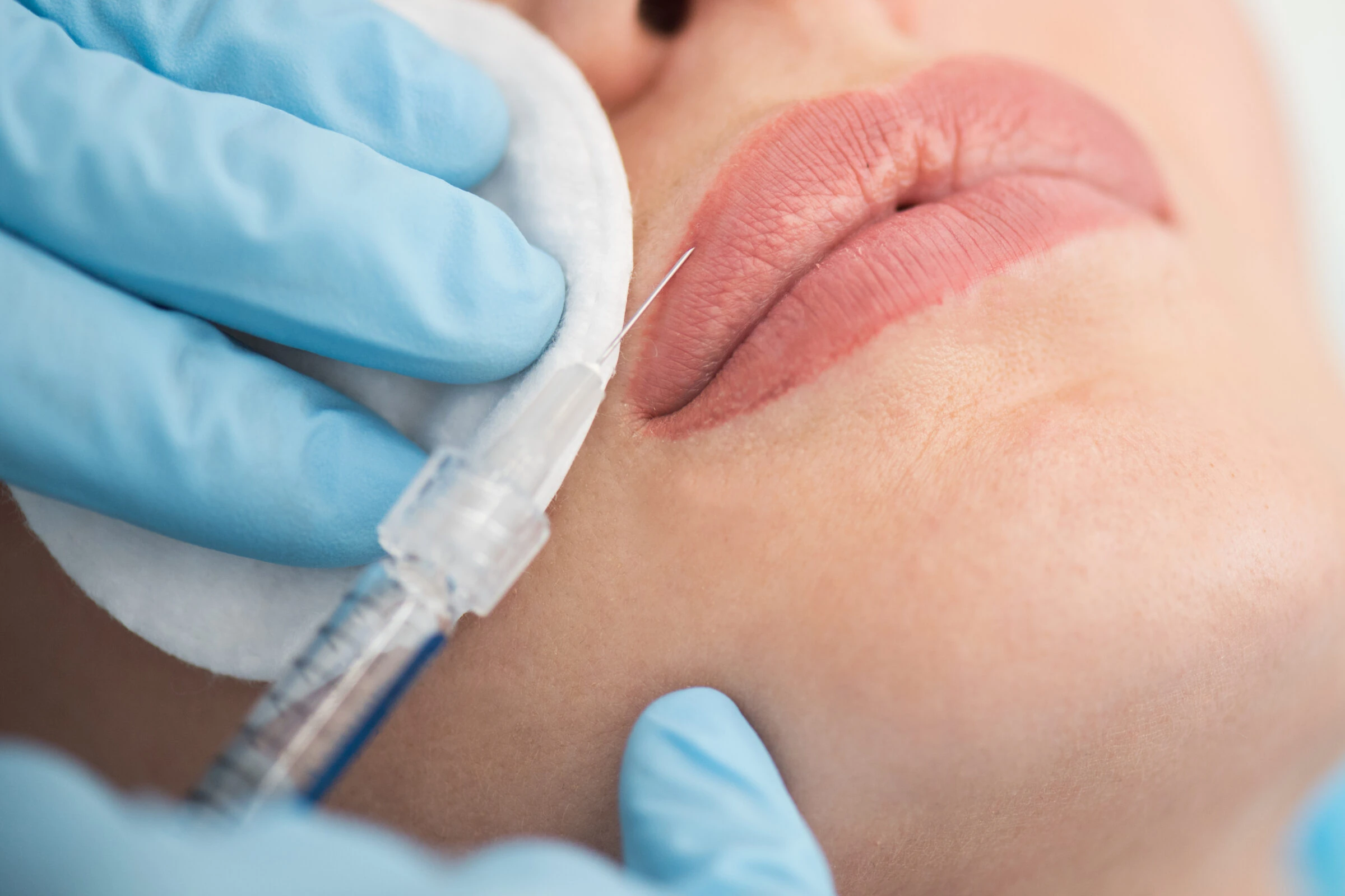 Cirugía estética en Bilbao: primer plano de los labios de una paciente durante un tratamiento estético