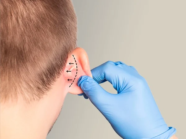 Otoplastia y lobuloplastia en Bilbao: corrección de la forma y la posición de la oreja