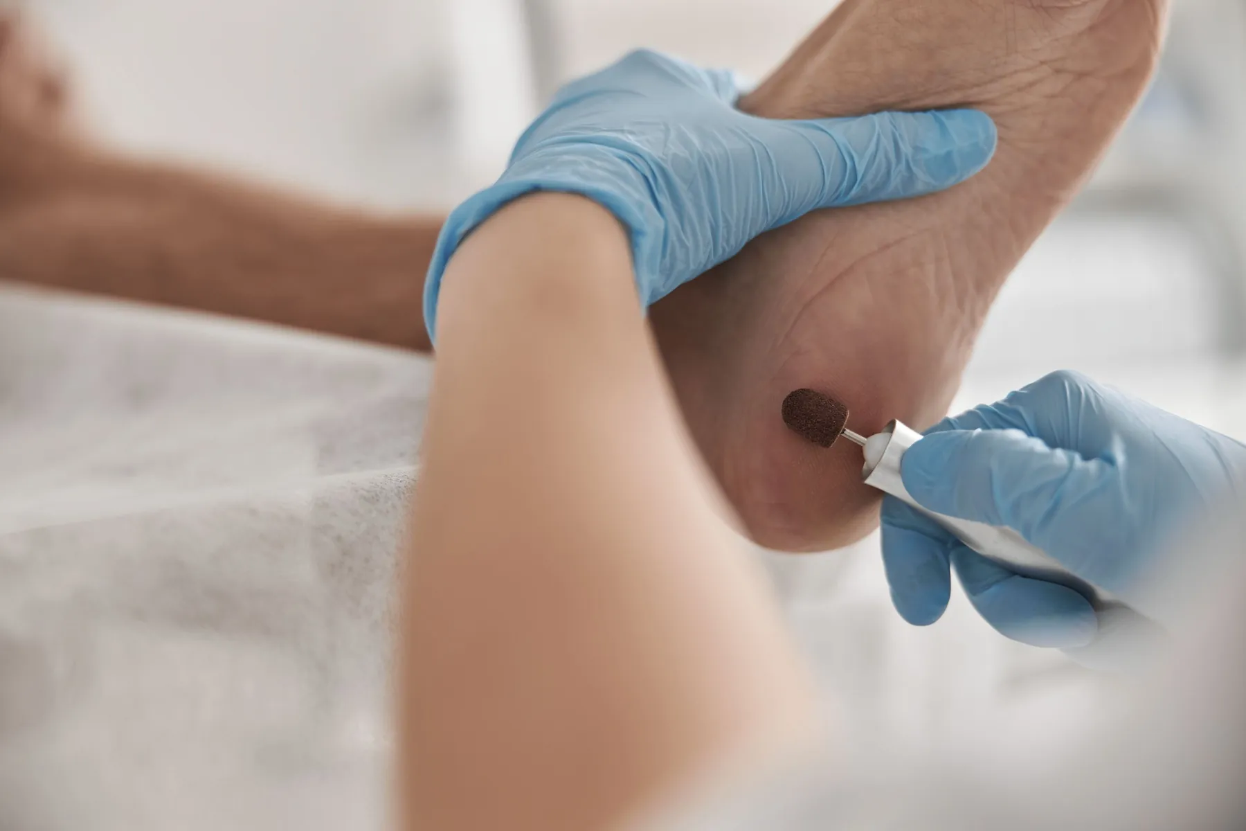La podóloga trata la zona afectada con instrumental estéril, en un tratamiento de Papiloma plantar de Clínica Malai en Bilbao y Mungia