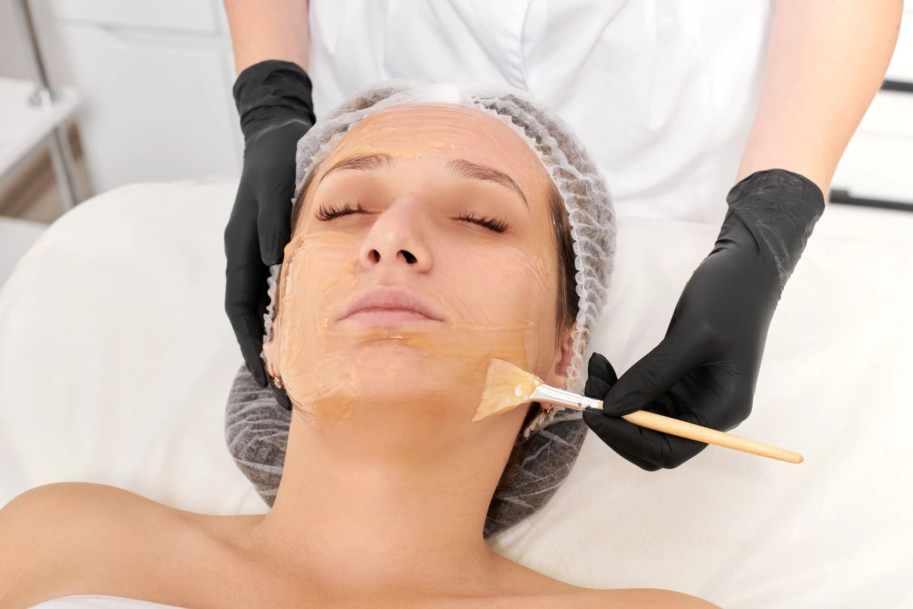 Rejuvenecimiento facial en Bilbao: peeling de fenol en Bilbao: aplicación del preparado sobre el rostro de la paciente