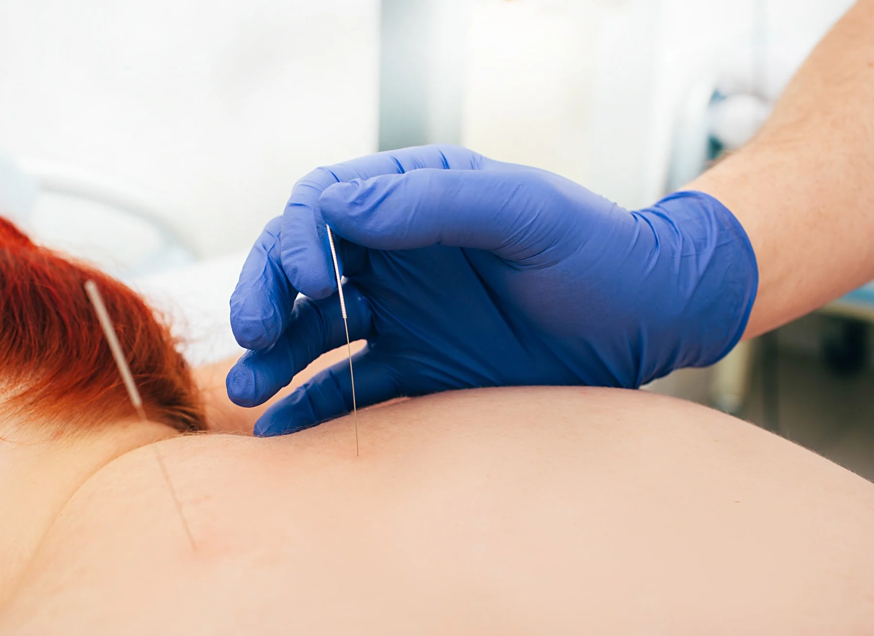 Sesión de punción seca sobre la musculatura de la espalda, en un tratamiento de Punción seca de Clínica Malai en Bilbao y Mungia