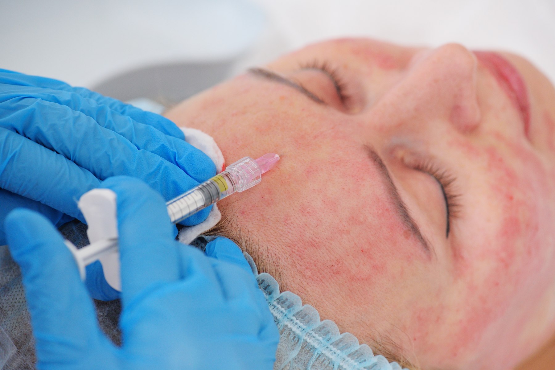 Aplicación del tratamiento sobre la lesión vascular del rostro, en un tratamiento de Rosácea y cuperosis de Clínica Malai en Bilbao