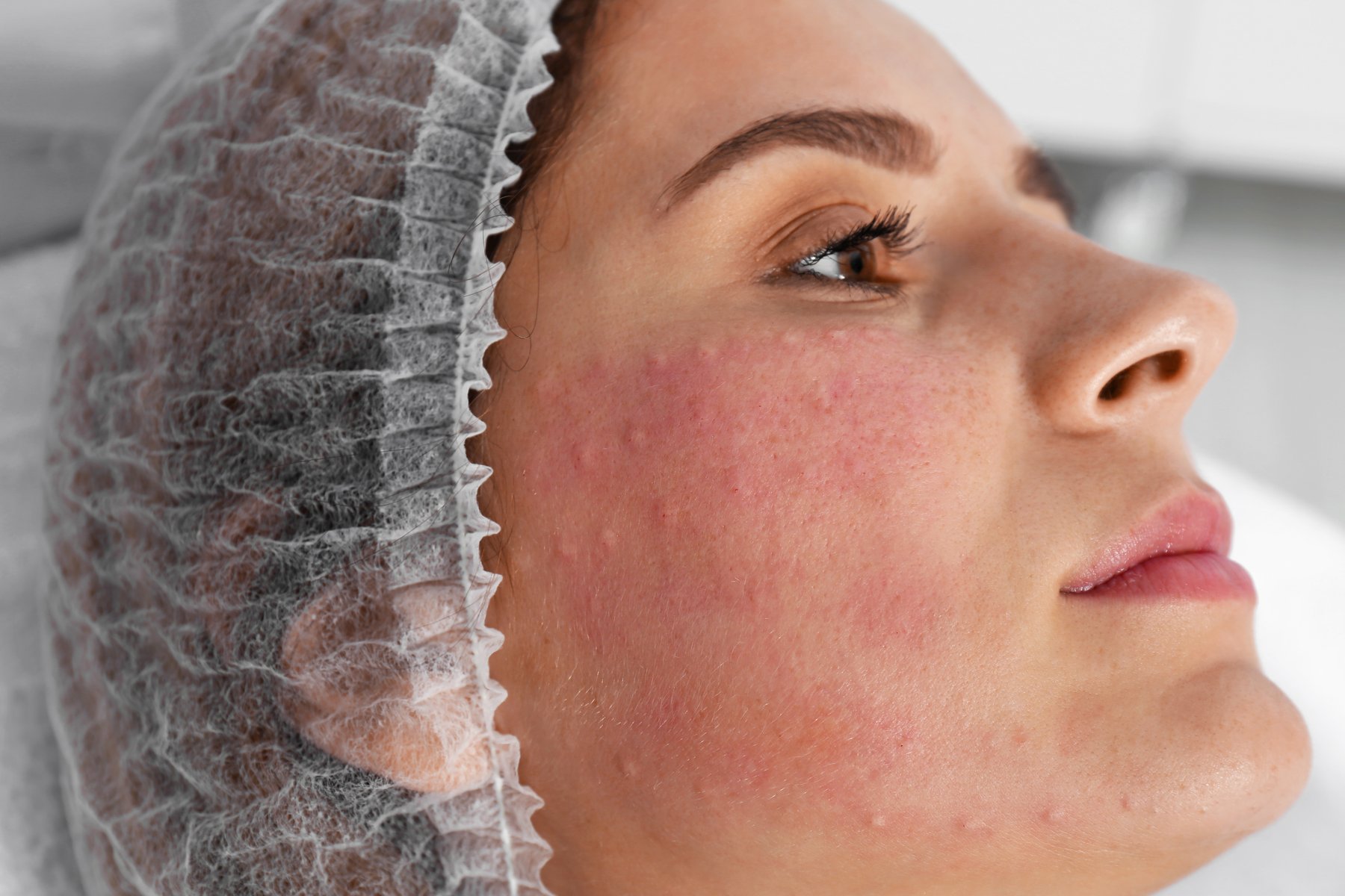Rosácea y cuperosis en Bilbao: sesión de tratamiento facial en la clínica