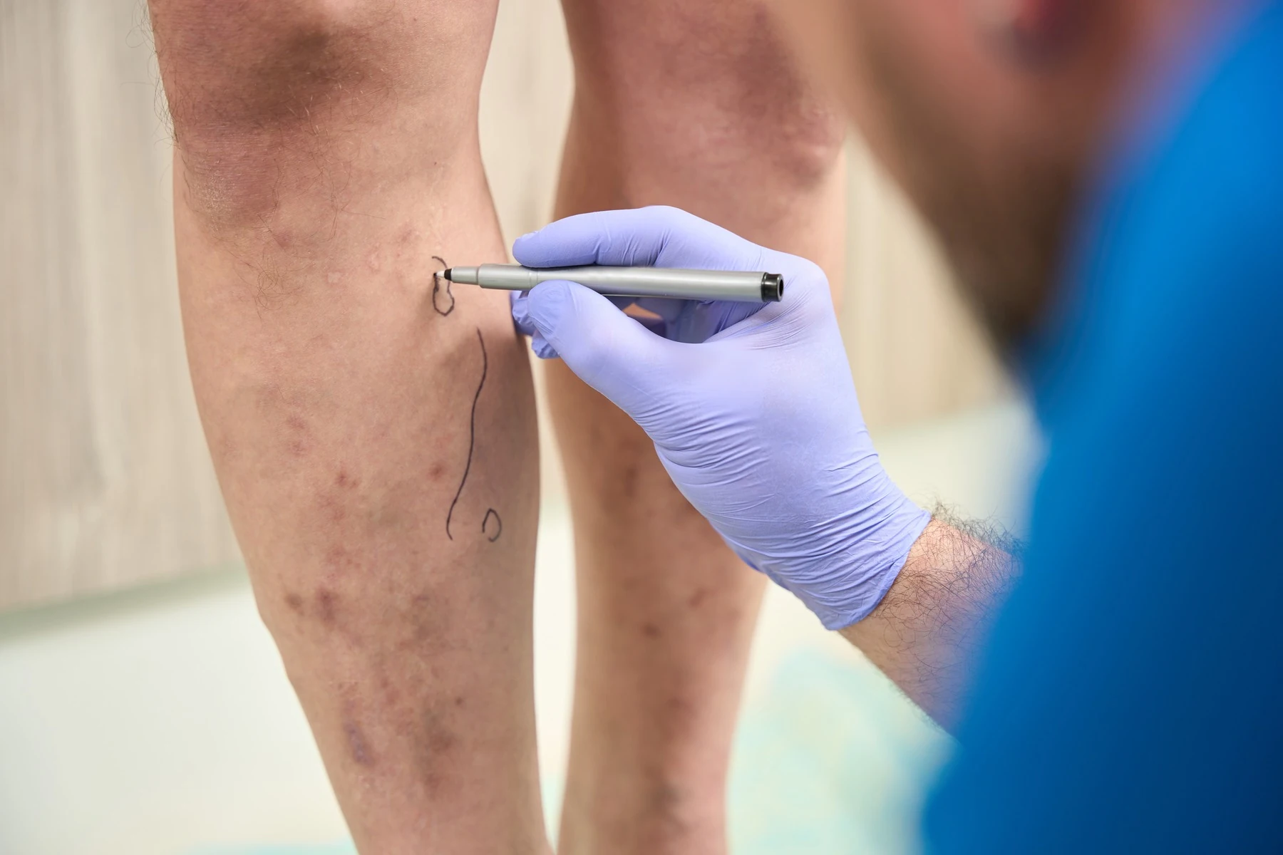 El médico marca sobre la pierna las venas que se van a tratar, en un tratamiento de Varices y arañas vasculares de Clínica Malai en Bilbao