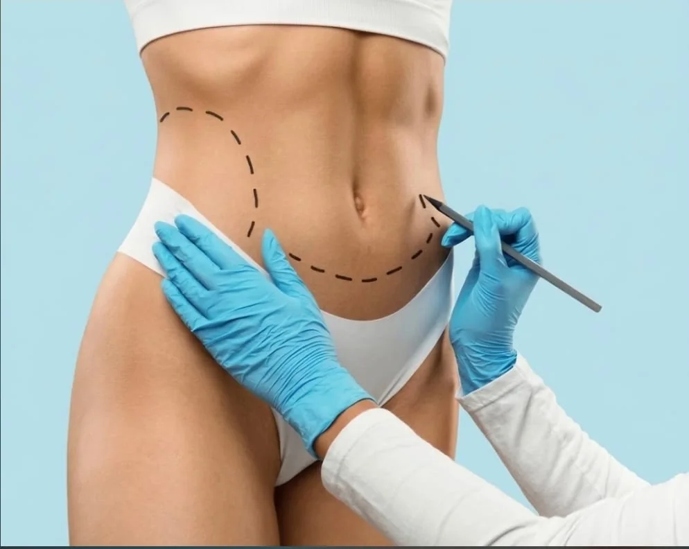 Abdominoplastia en Bilbao: marcaje del abdomen antes de la cirugía