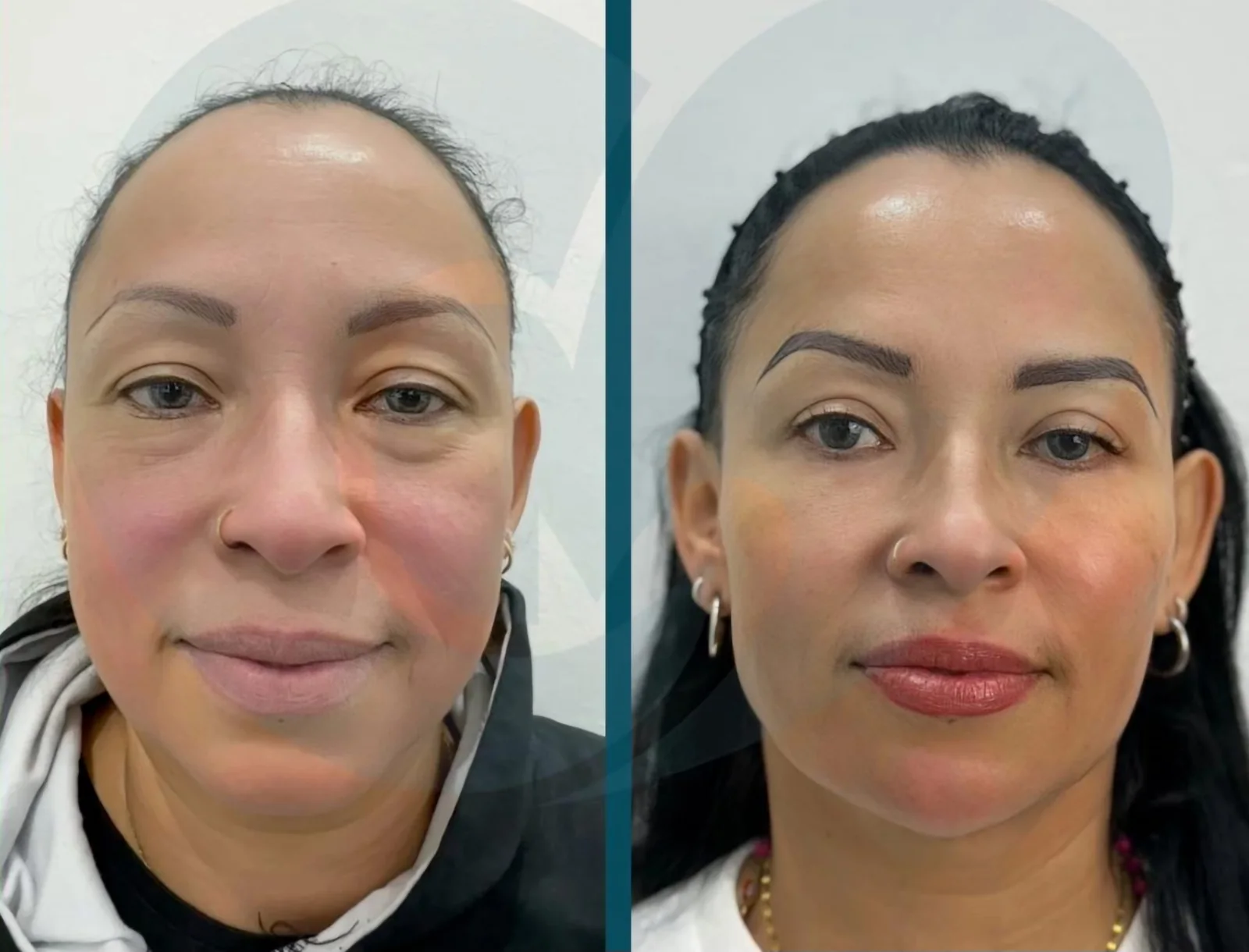 Armonización facial en Bilbao: antes y después de una paciente de Clínica Malai