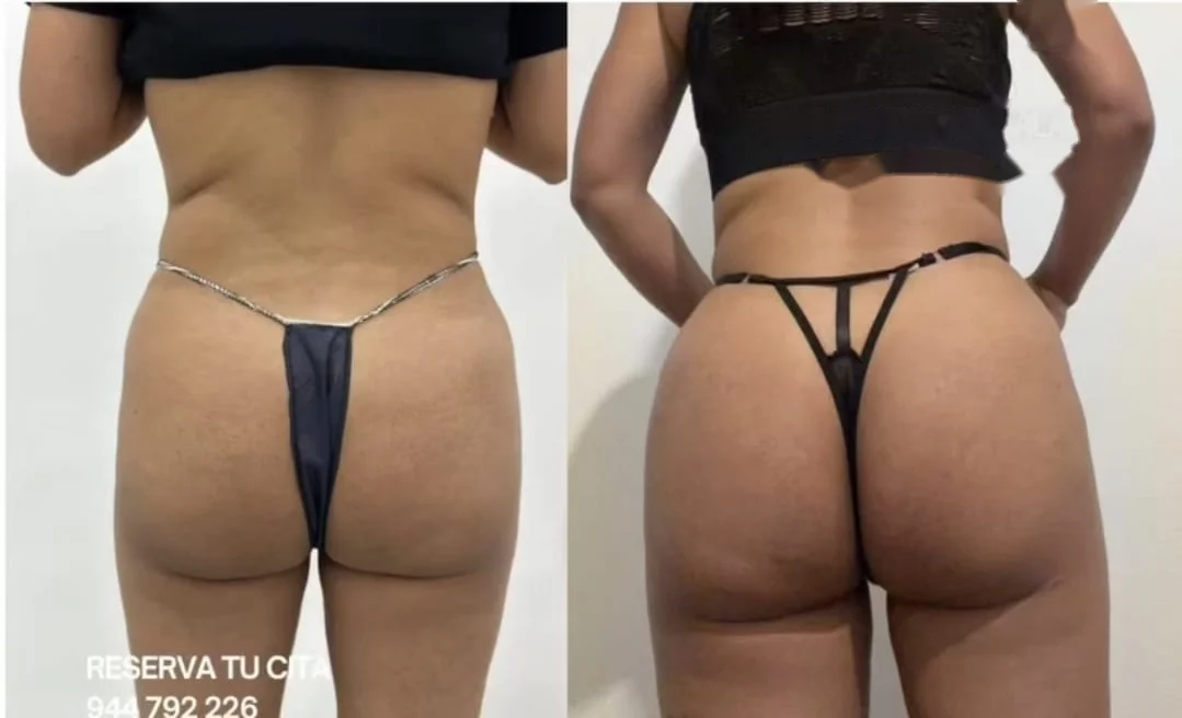 Aumento de glúteos sin cirugía en Bilbao: antes y después de una paciente de Clínica Malai