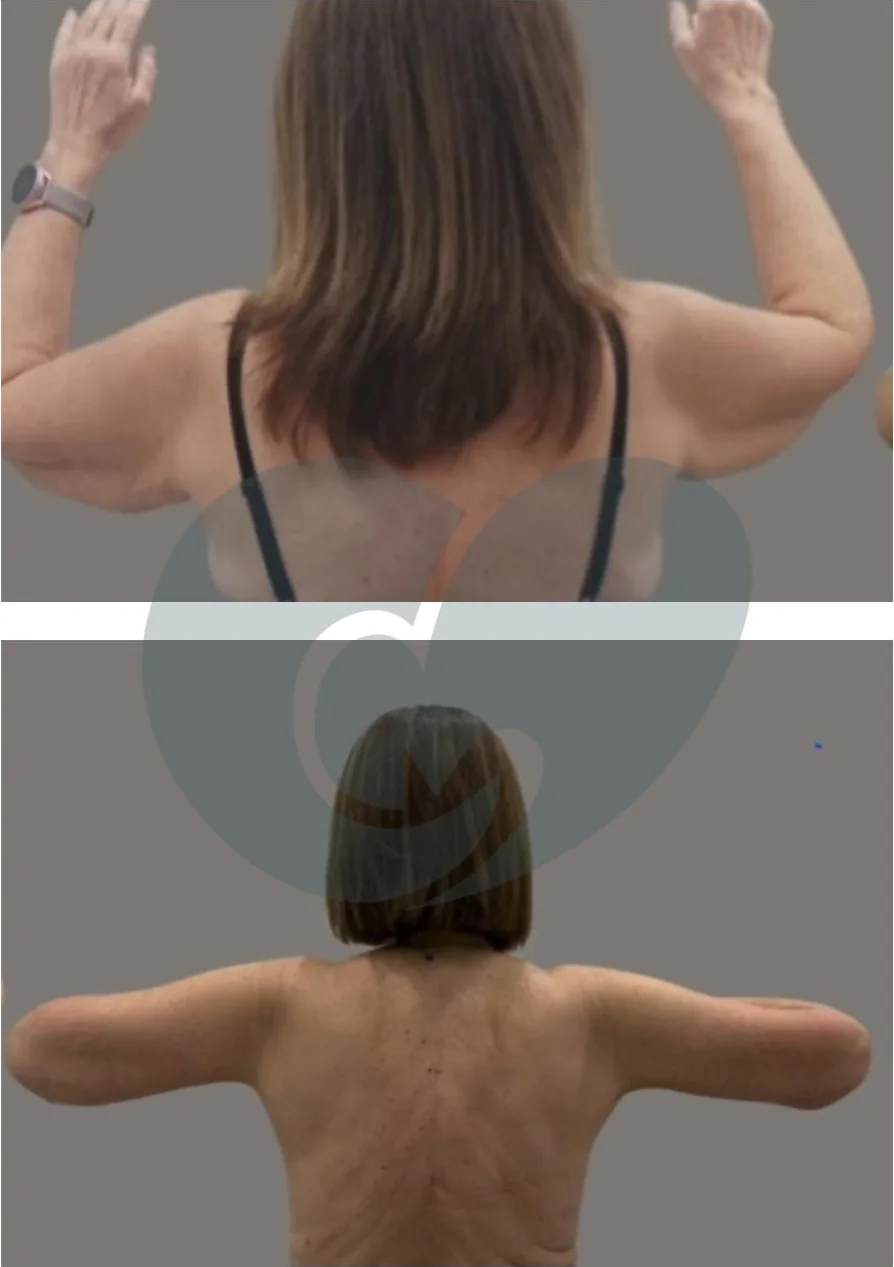 Braquioplastia en Bilbao: antes y después del lifting de brazos