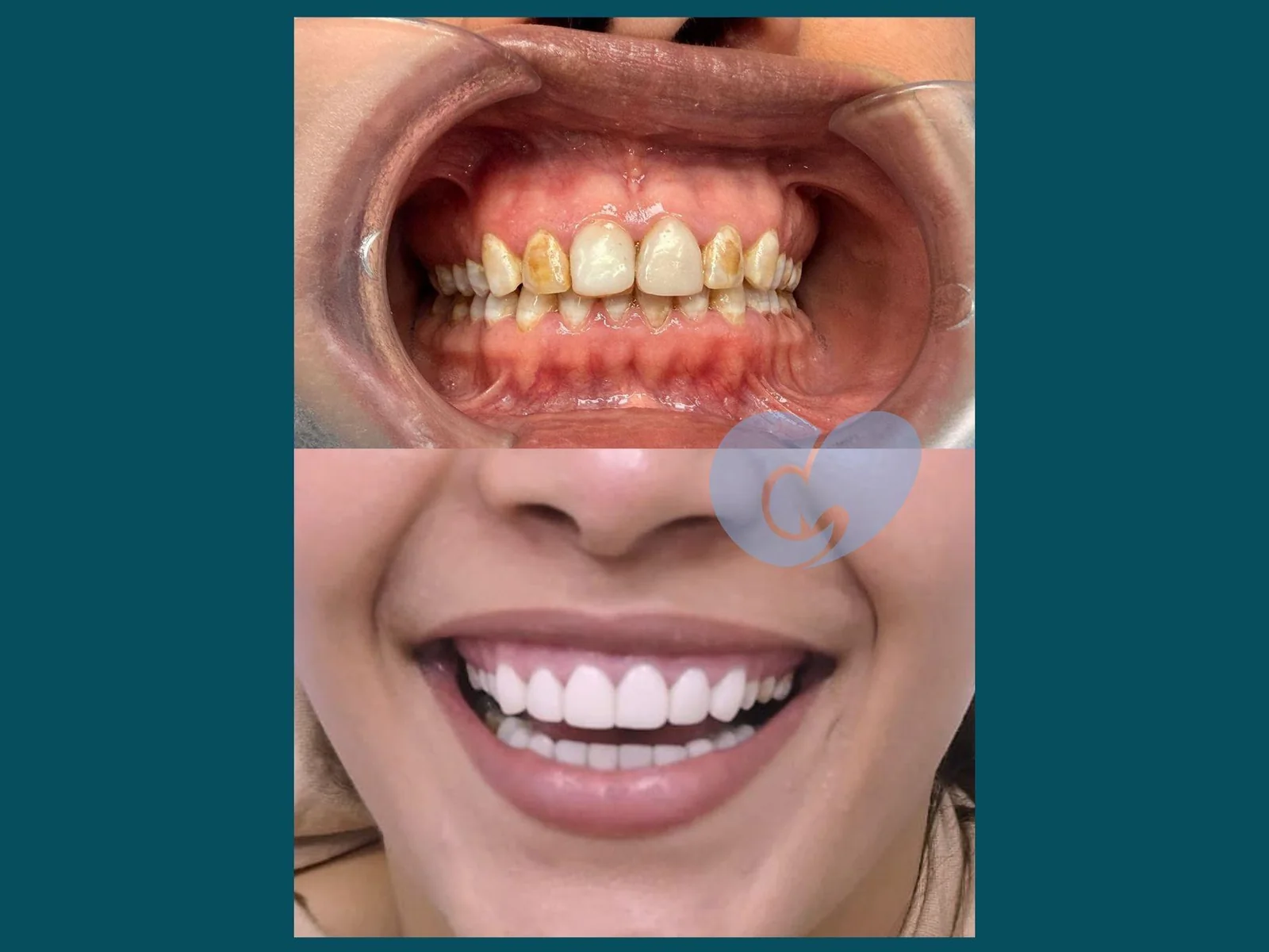 Carillas dentales en Bilbao: sonrisa antes y después del tratamiento