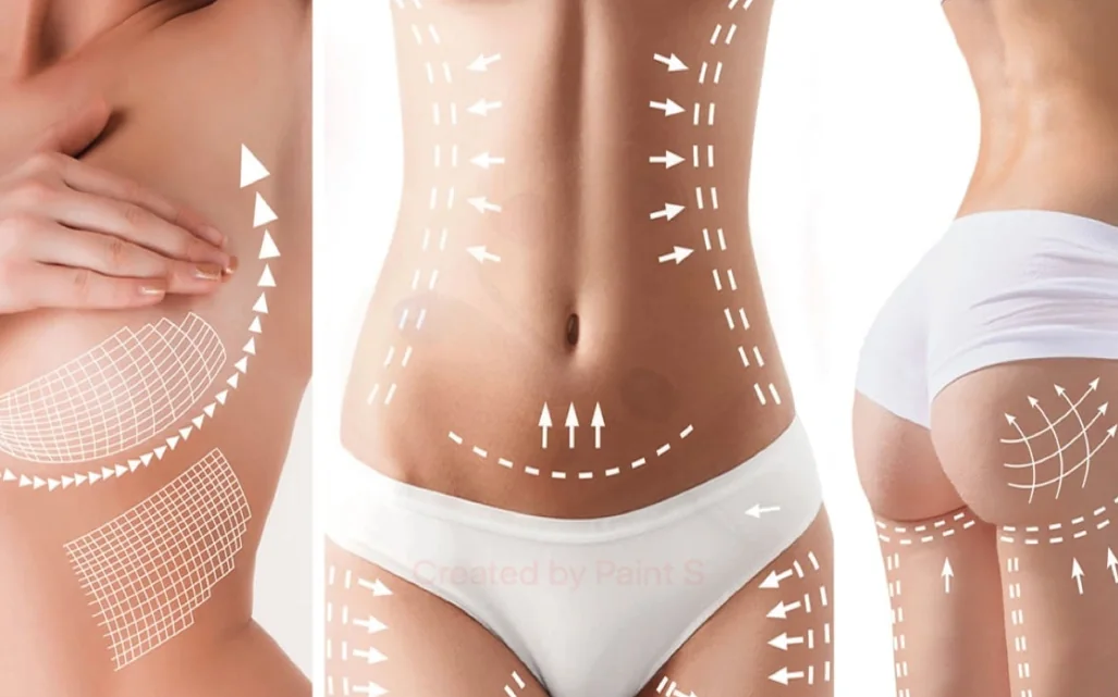 Cirugía estética corporal en Bilbao: marcaje de pecho, abdomen y glúteos