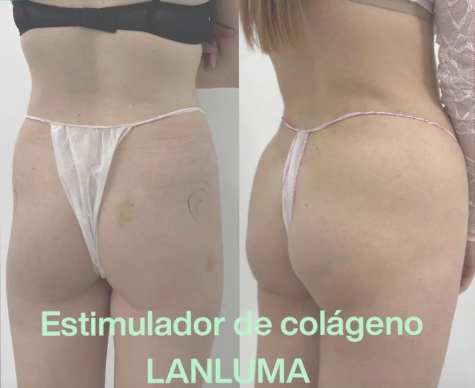 Proyección de glúteos con estimulador de colágeno en Bilbao: antes y después