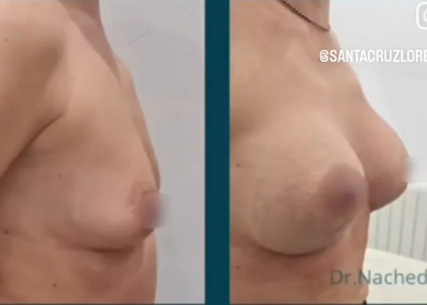 Lifting de mamas en Bilbao: antes y después de una paciente del Dr. Nached