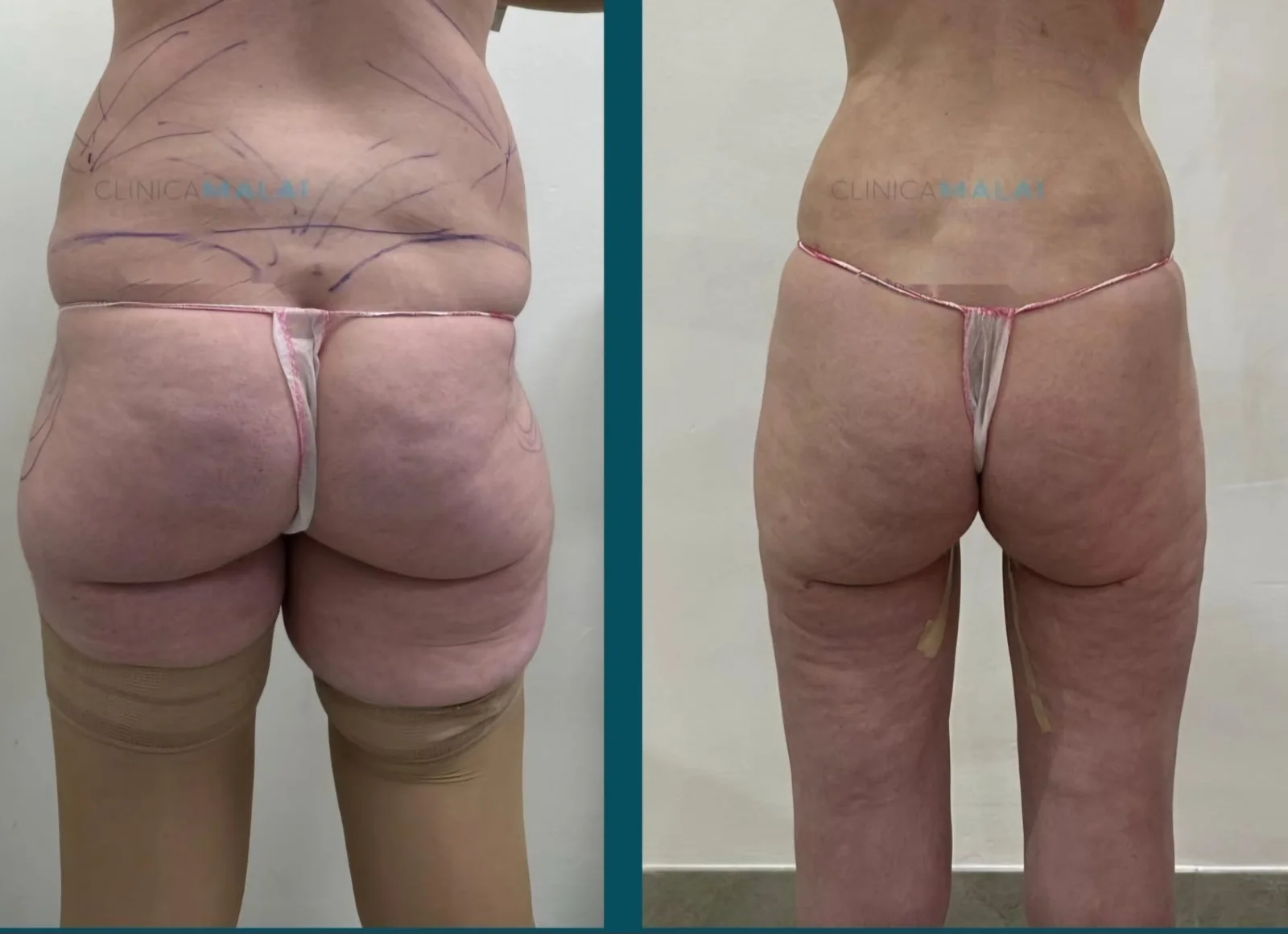 Lipoescultura en Bilbao: antes y después de una paciente de Clínica Malai