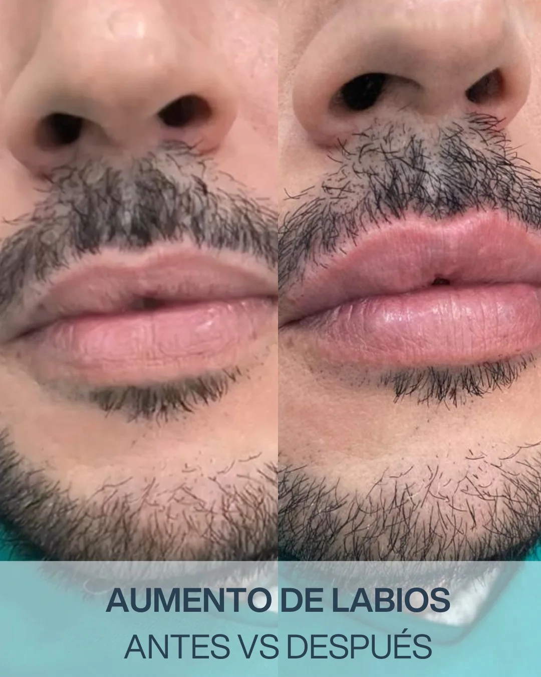 Medicina estética facial en Bilbao: infiltración facial en Clínica Malai