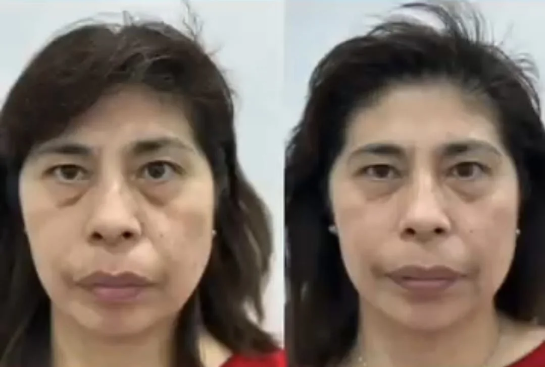 Armonización de pómulos en Bilbao: antes y después de una paciente de Clínica Malai