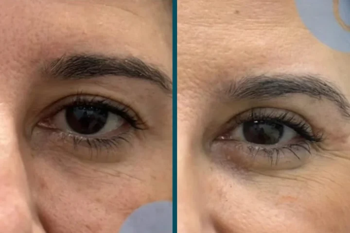 Blefaroplastia en Bilbao: antes y después del párpado de una paciente de Clínica Malai