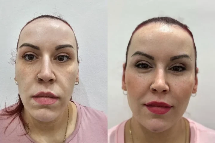Fullface y facial luxury en Bilbao: antes y después de una paciente de Clínica Malai