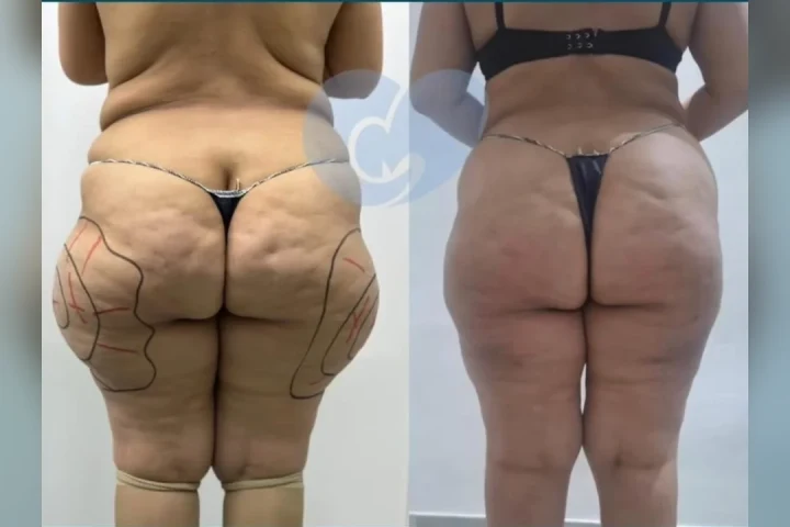 Lipoescultura en Bilbao: antes y después de una paciente de Clínica Malai